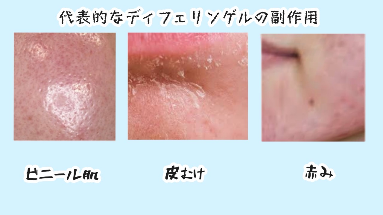 �f�B�t�F�����Q�� ����p �炢